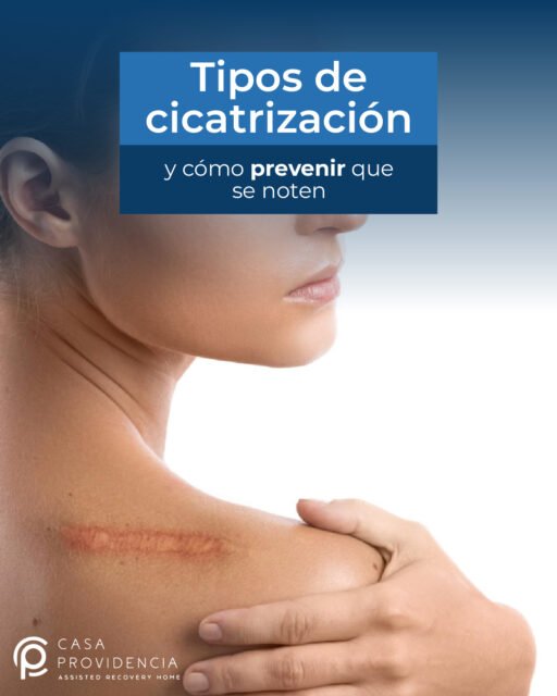 Cada piel cicatriza de forma distinta y necesita cuidados específicos. En Casa Providencia contamos con enfermeras altamente capacitadas para pacientes que se acaban de realizar una cirugía. El acompañamiento correcto después de una cirugía marca la diferencia.
Cuidar tu recuperación también es cuidar tu resultado final 🤍🩹✨